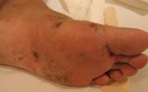 Περιγραφ: http://www.hellenicdermatlas.com/photos/0000/0468/00000468_standalone.jpg