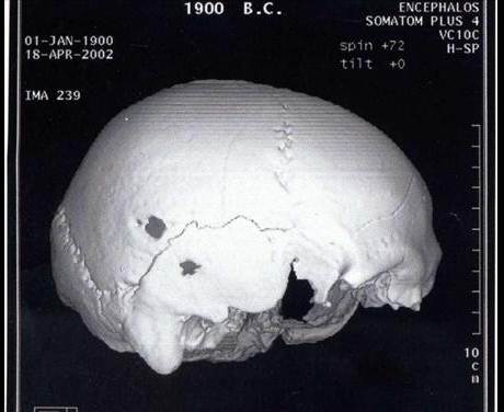 Στους Δελφος το 1900 π.Χ. η πρτη νευροχειρουργικ επμβαση στην Ελλδα
